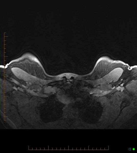 File:Axillary lymphadenopathy on breast MRI- yellow fever vaccination induced (Radiopaedia 19454-19483 Axial T1 C+ fat sat 3).jpg