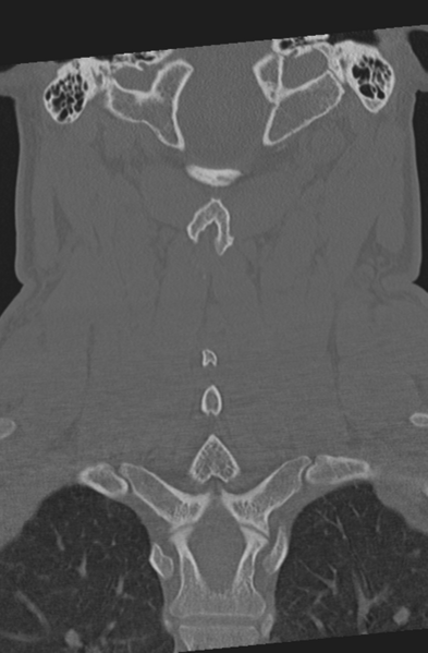 File:Axis peg fracture (type 3) and atlas lateral mass (type 4) fracture (Radiopaedia 37474-39324 Coronal bone window 38).png