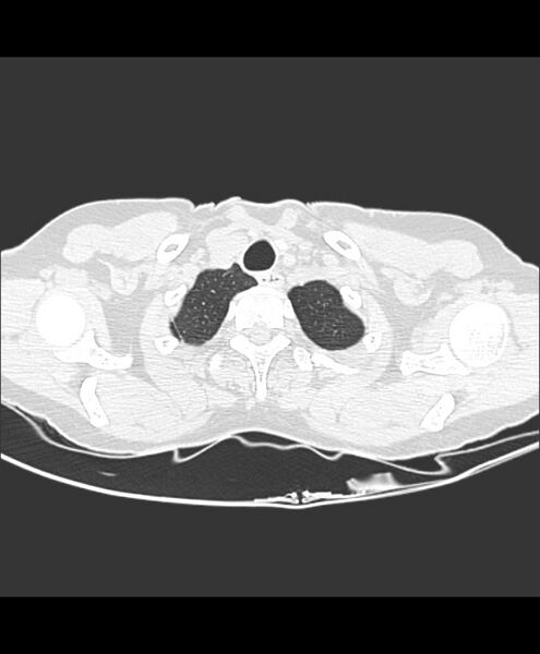 File:Azygos fissure and azygos lobe (Radiopaedia 41841-44832 Axial lung window 33).jpg
