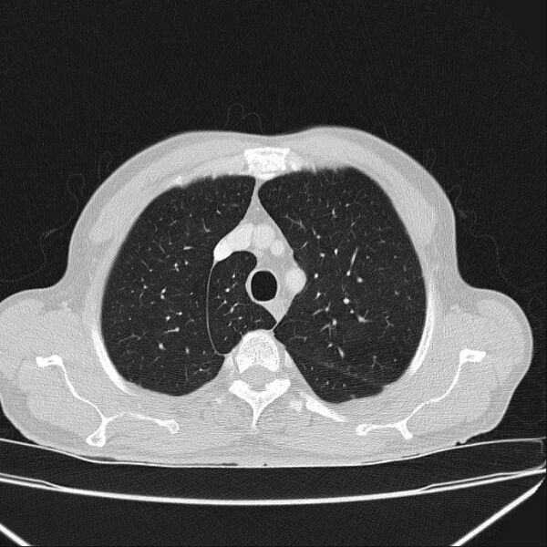 File:Azygos lobe (Radiopaedia 38259-40275 Axial lung window 17).jpg