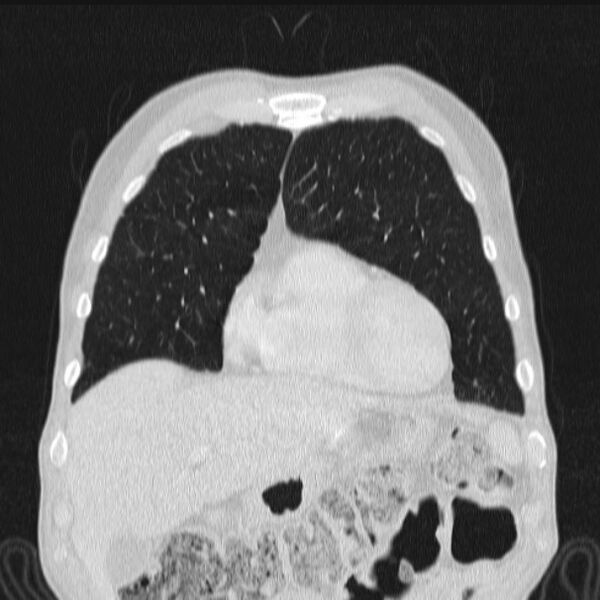File:Azygos lobe (Radiopaedia 38259-40275 Coronal lung window 20).jpg
