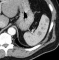 B-cell lymphoma involving the spleen (Radiopaedia 15869).jpg