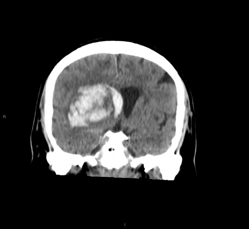 Basal ganglia hemorrhage (Radiopaedia 58763-65985 Coronal non-contrast 43).jpg