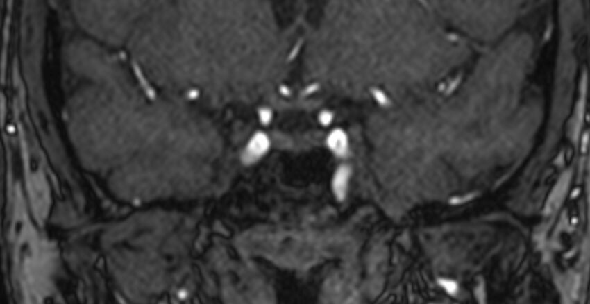 Basilar artery fenestration (Radiopaedia 74537-85455 Coronal MRA TOF 6).jpg