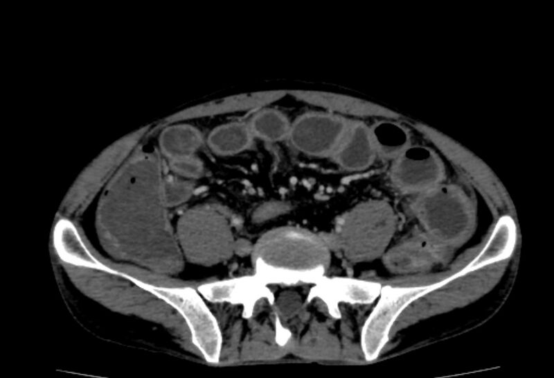 File:Behçet's disease- abdominal vasculitis (Radiopaedia 55955-62570 A 61).jpg