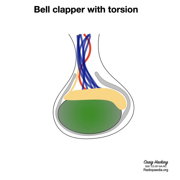 File:Bell clapper deformity (diagram) (Radiopaedia 86124-102079 E 1).jpeg