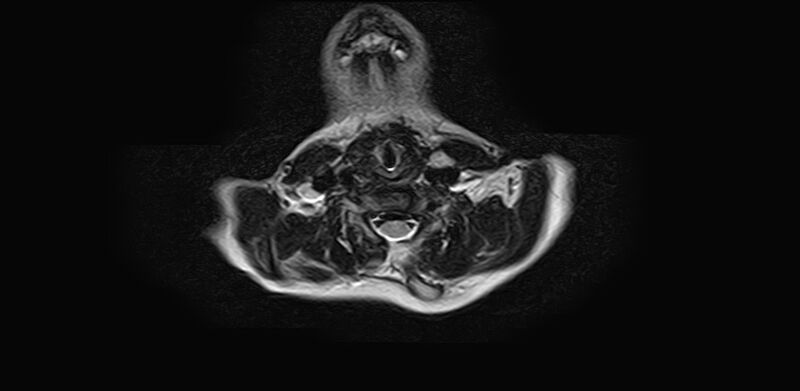 File:Bilateral Sprengel deformity with Klippel-Feil syndrome (Radiopaedia 66395-75650 Axial T2 14).jpg