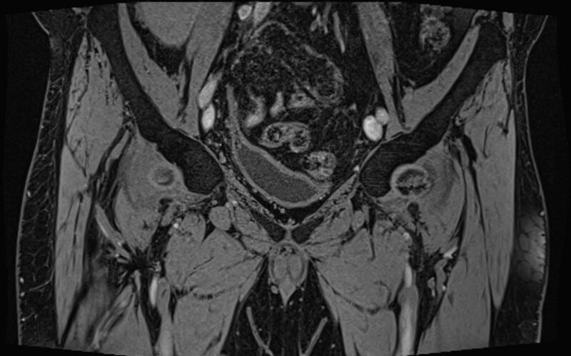 File:Bilateral avascular necrosis of femoral head (Radiopaedia 77116-89078 Coronal T2 we 72).jpg