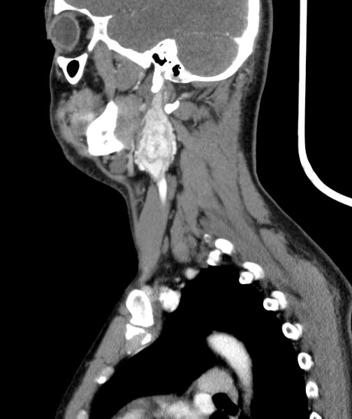 File:Bilateral carotid body tumors (Radiopaedia 52899-58827 C 43).jpg