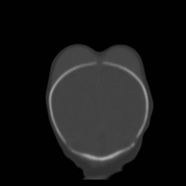 File:Bilateral cephalohematomas and subdural hematomas (Radiopaedia 26778-26929 Coronal bone window 29).jpg