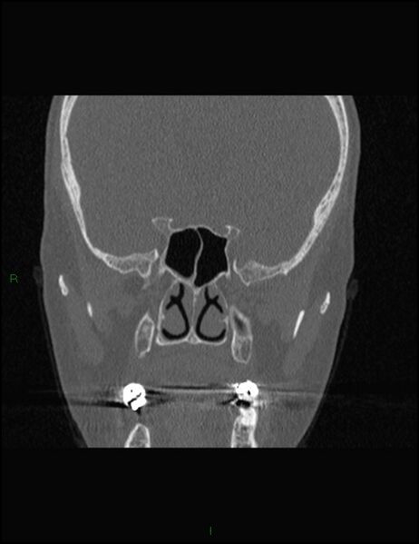 File:Bilateral frontal mucoceles (Radiopaedia 82352-96454 Coronal 198).jpg