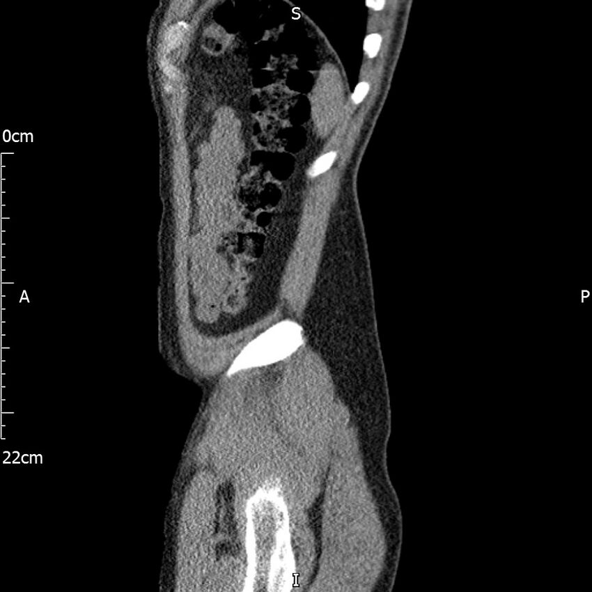 Bilateral medullary nephrocalcinosis with ureteric calculi (Radiopaedia 71269-81569 C 20).jpg