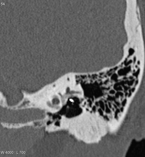 File:Bilateral otosclerosis with left stapes prosthesis (Radiopaedia 5567-7302 D 6).jpg