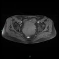 Bilateral ovarian fibroma (Radiopaedia 44568-48293 Axial T1 fat sat 17).jpg