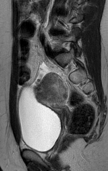 File:Bilateral ovarian fibrothecomas - adolescent (Radiopaedia 86604-102707 Sagittal T2 21).jpg
