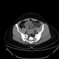 Bilateral ovarian mature cystic teratomas (Radiopaedia 79373-92457 Axial non-contrast 56).jpg