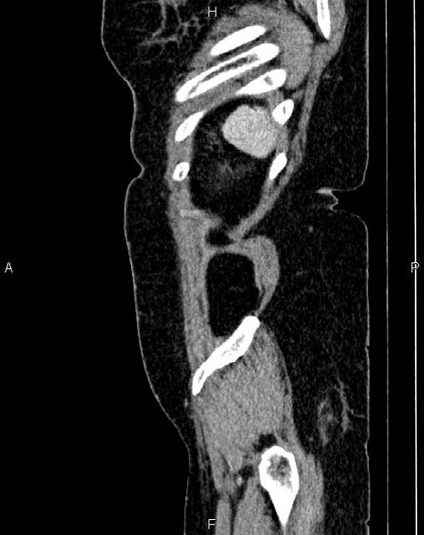 File:Bilateral ovarian serous cystadenocarcinoma (Radiopaedia 86062-101989 E 82).jpg