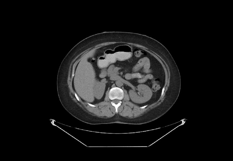 File:Bilateral urolithiasis with incidentally detected splenic artery aneurysm and left inferior vena cava (Radiopaedia 44467-48123 Axial non-contrast 18).jpg