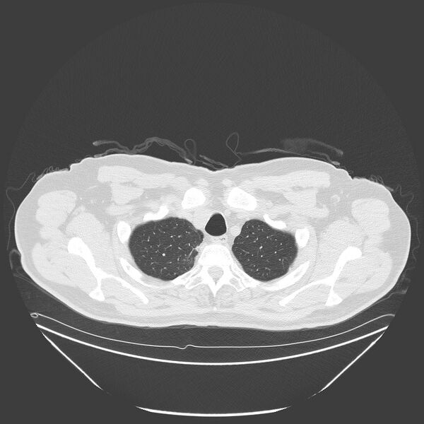 File:Birt-Hogg-Dubé syndrome (Radiopaedia 52578-58491 Axial lung window 7).jpg