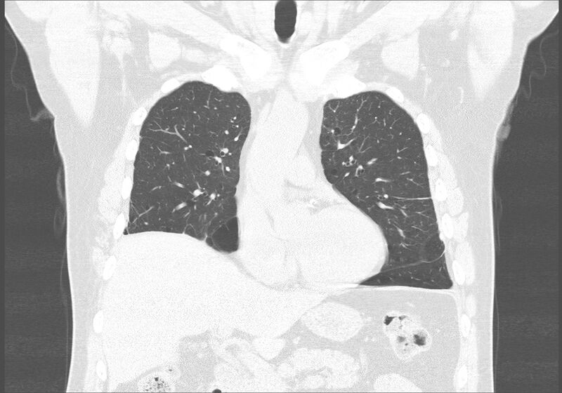 File:Birt-Hogg-Dubé syndrome (Radiopaedia 52578-58491 Coronal lung window 18).jpg