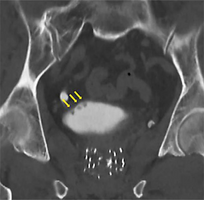 CT Urography shows multiple tumors