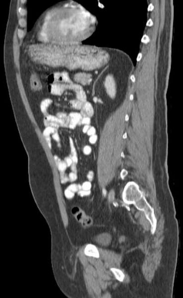 File:Bleeding duodenal ulcer and adenomyomatosis of gallbladder (Radiopaedia 61834-69861 C 64).jpg