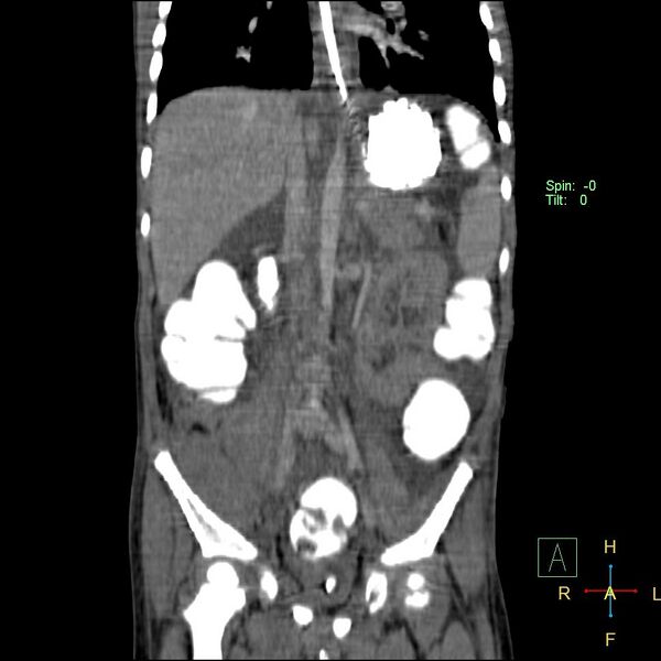 File:Blunt abdominal trauma (Radiopaedia 24780-25044 C 12).jpg