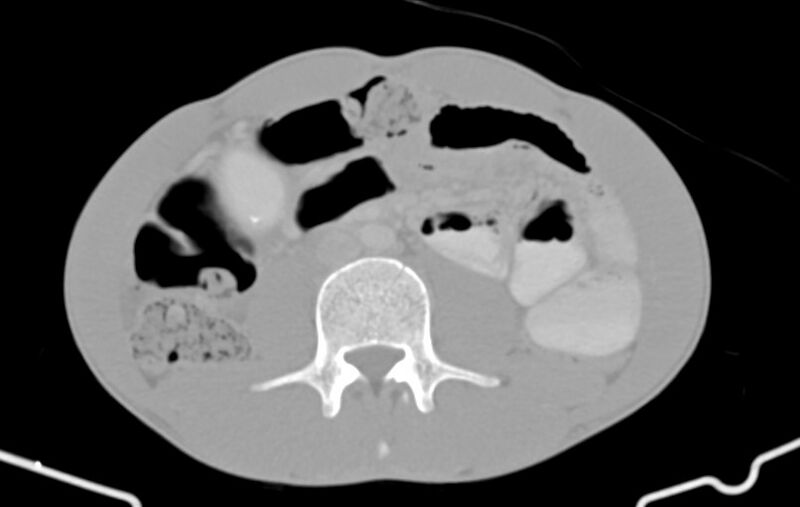 File:Blunt injury to the small bowel (Radiopaedia 74953-85987 Axial Wide 49).jpg
