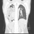 Bochdalek diaphragmatic hernia (Radiopaedia 38866-41059 Coronal lung window 15).jpg