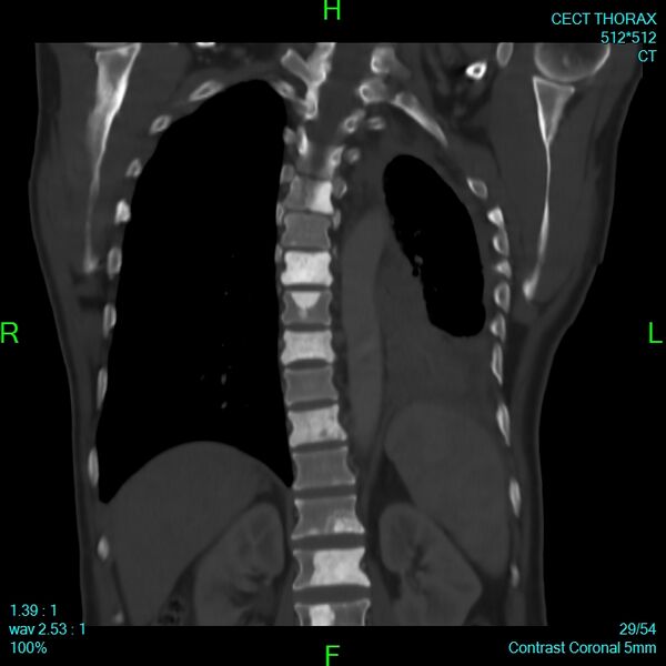File:Bone metastases from lung carcinoma (Radiopaedia 54703-60937 Coronal bone window 29).jpg