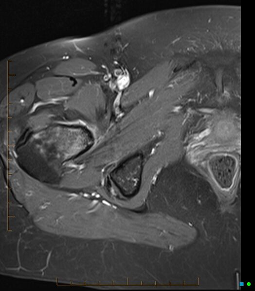 File:Bone metastasis - breast cancer (Radiopaedia 16667-16374 Axial T1 C+ fat sat 7).jpg
