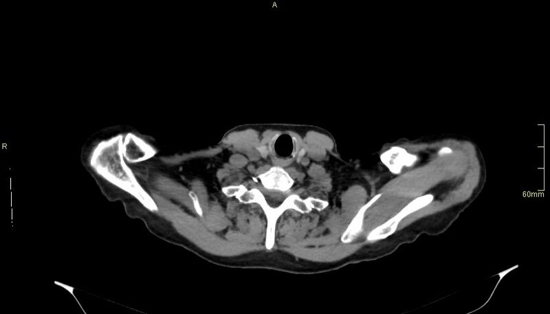 File:Brachial artery foreign body (Radiopaedia 54583-60820 Axial non-contrast 6).jpg