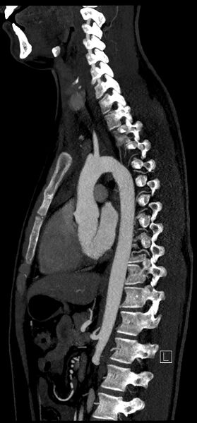 File:Brachiocephalic trunk pseudoaneurysm (Radiopaedia 70978-81191 C 54).jpg