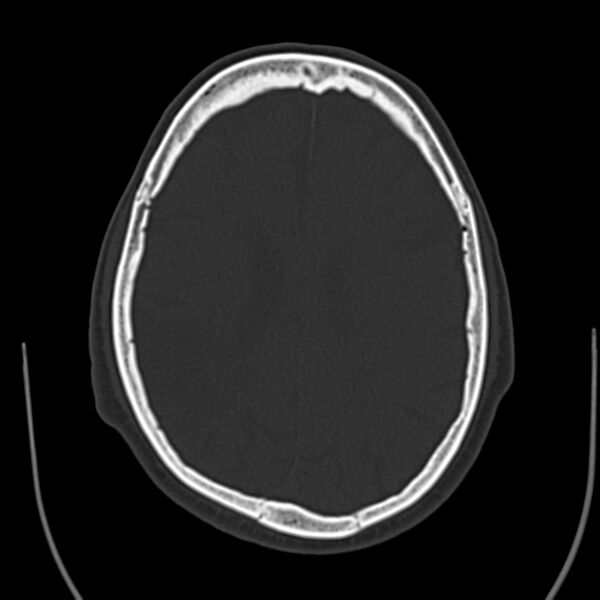 File:Brain Pantopaque remnants (Radiopaedia 78403-91048 Axial bone window 45).jpg