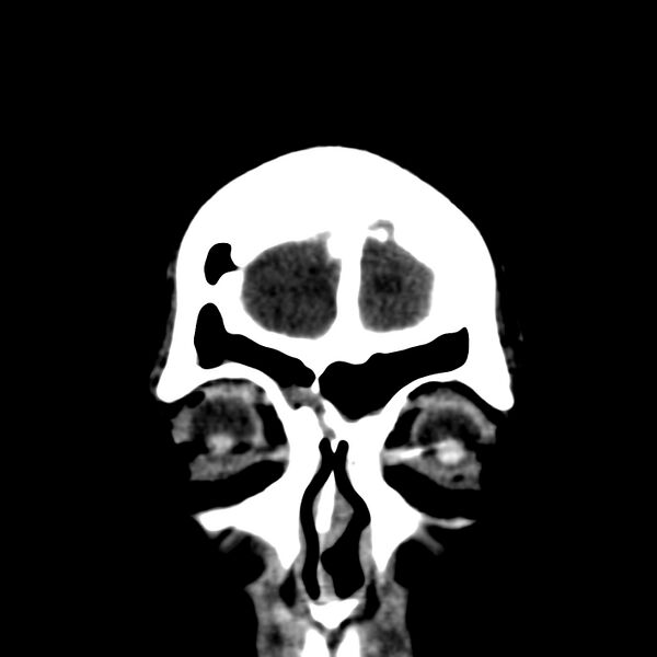 File:Brain Pantopaque remnants (Radiopaedia 78403-91048 Coronal non-contrast 7).jpg