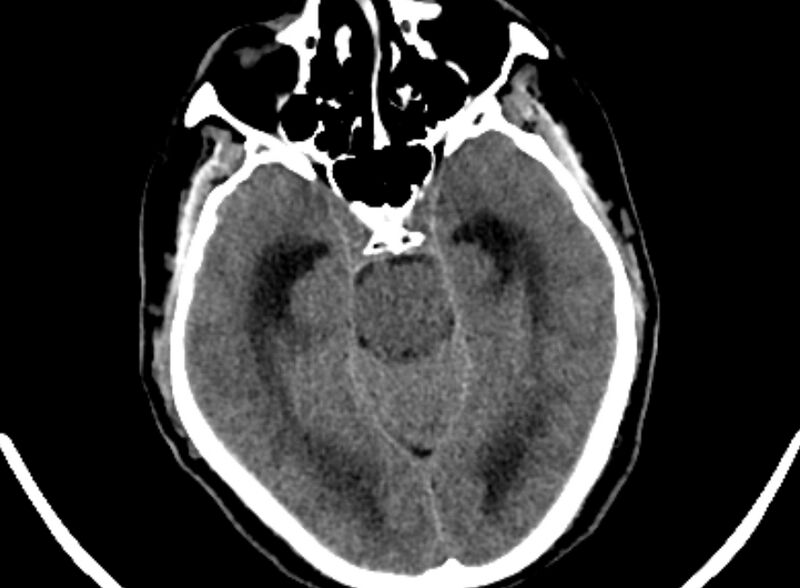 File:Brain abscess complicated by intraventricular rupture and ventriculitis (Radiopaedia 82434-96575 Axial non-contrast 7).jpg