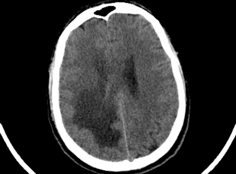 File:Brain abscess complicated by intraventricular rupture and ventriculitis (Radiopaedia 82434-96575 Axial non-contrast 75).jpg