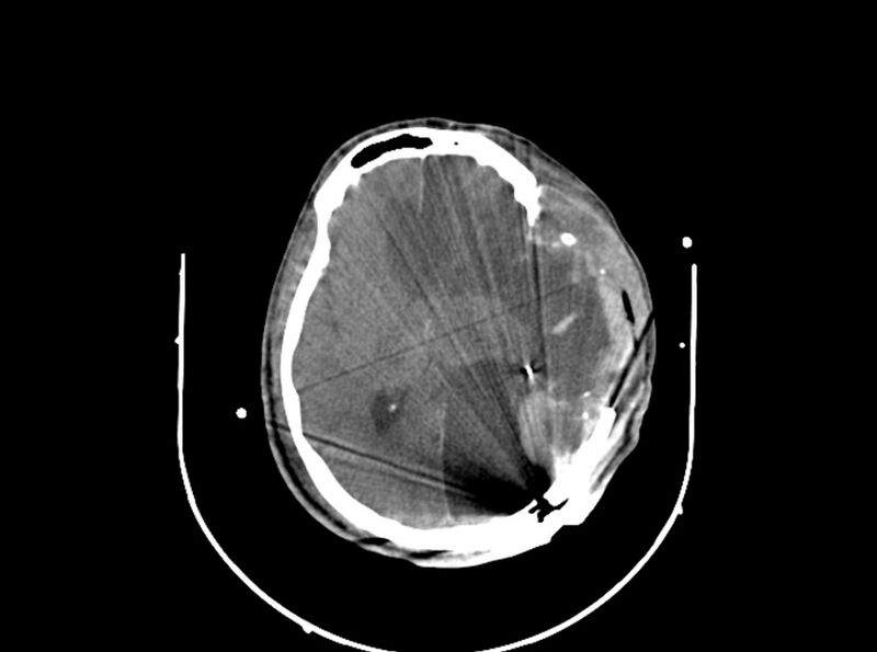 File:Brain injury by firearm projectile (Radiopaedia 82068-96087 B 107).jpg