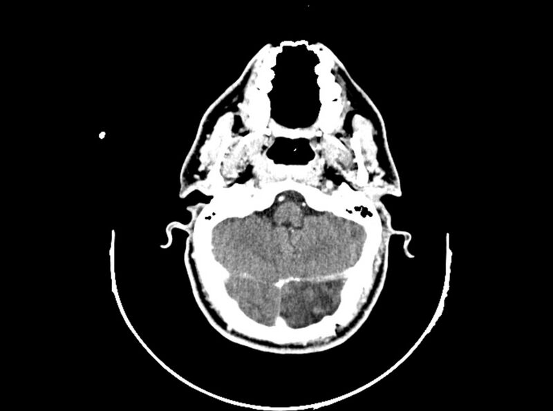 File:Brain injury by firearm projectile (Radiopaedia 82068-96088 B 76).jpg