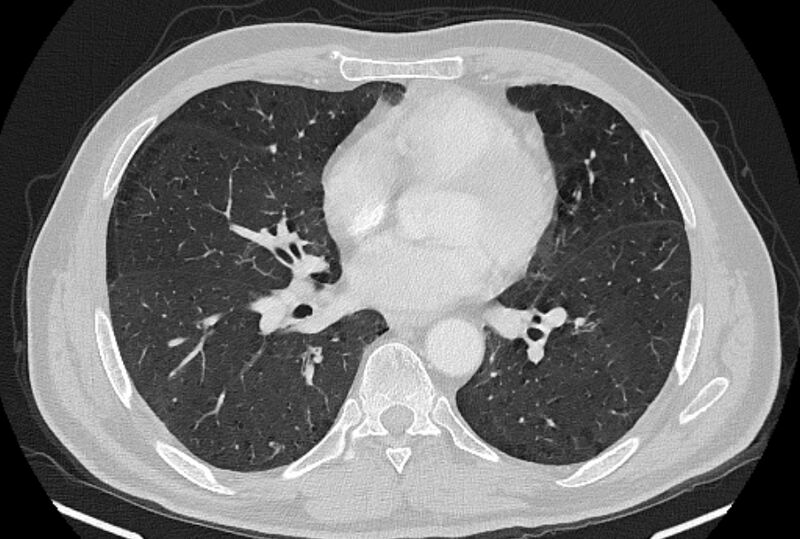 File:Brain metastases - lung cancer primary (Radiopaedia 75060-86116 Axial lung window 34).jpg