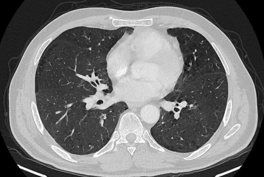 Brain metastases - lung cancer primary (Radiopaedia 75060-86116 Axial lung window 34).jpg