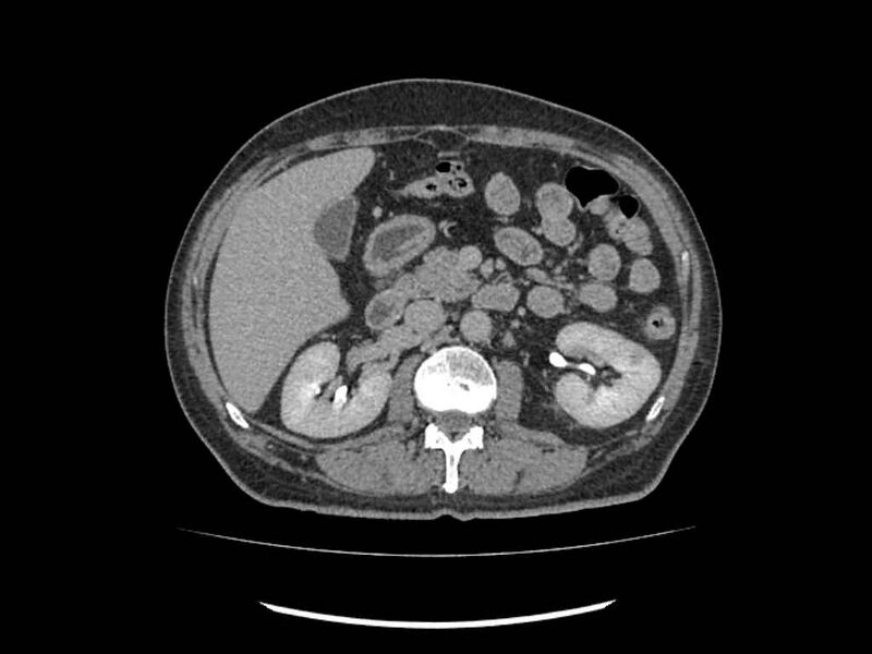 File:Brain metastases from renal cell carcinoma (Radiopaedia 42222-45328 Axial C+ delayed 86).jpg