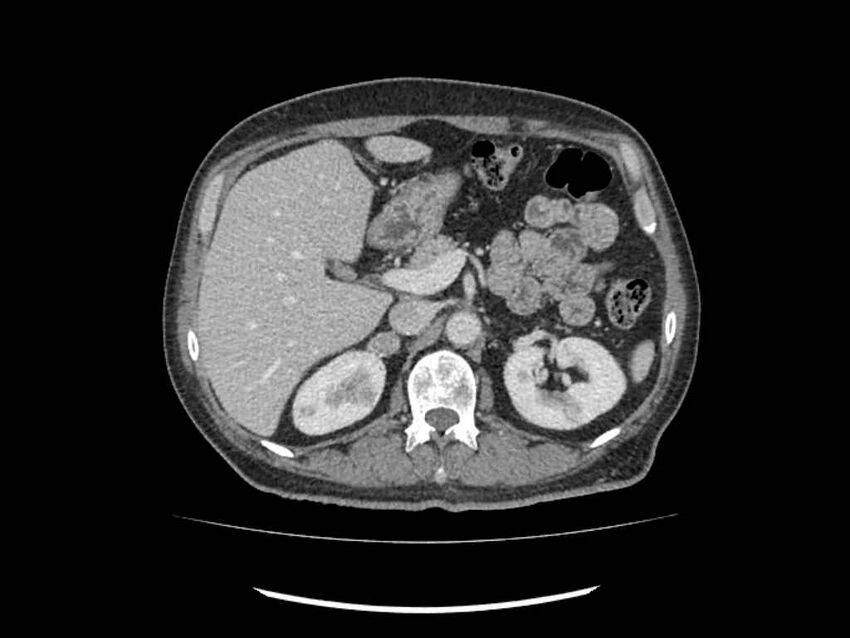 Brain metastases from renal cell carcinoma (Radiopaedia 42222-45328 B 56).jpg