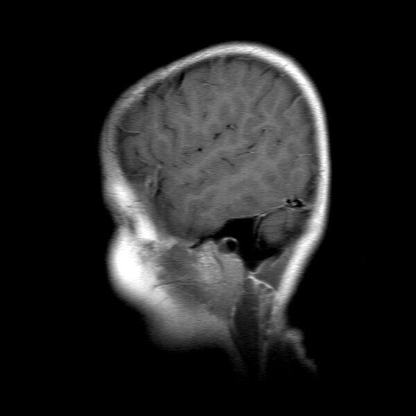 File:Brainstem ganglioglioma (Radiopaedia 10763-11224 Sagittal T1 C+ 3).jpg