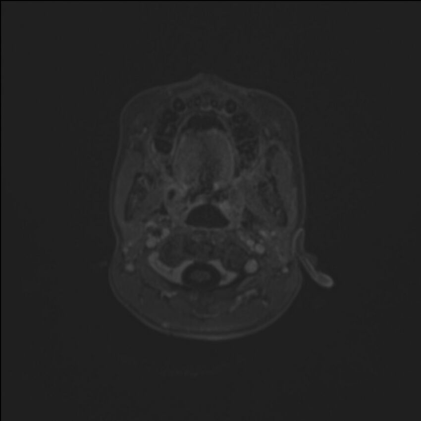Brainstem glioma (Radiopaedia 70548-80674 Axial T1 C+ 6).jpg