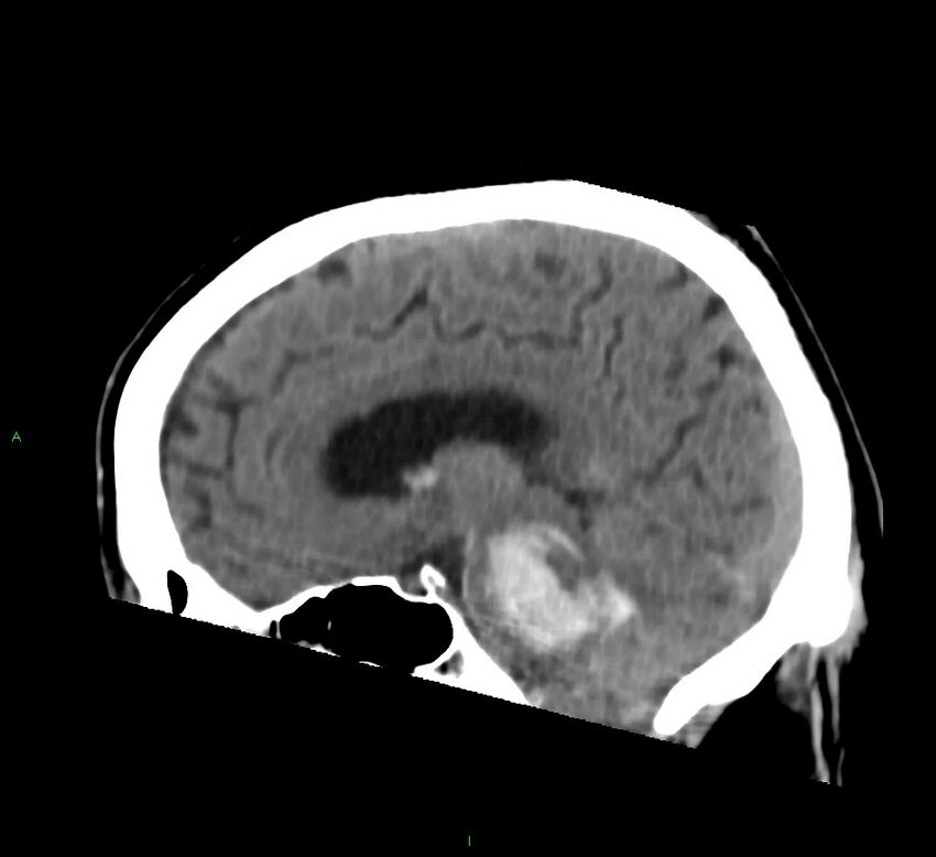 Brainstem hemorrhage (Radiopaedia 58794-66028 C 24).jpg
