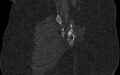 Breast carcinoma with pathological hip fracture (Radiopaedia 60314-67993 Coronal bone window 94).jpg