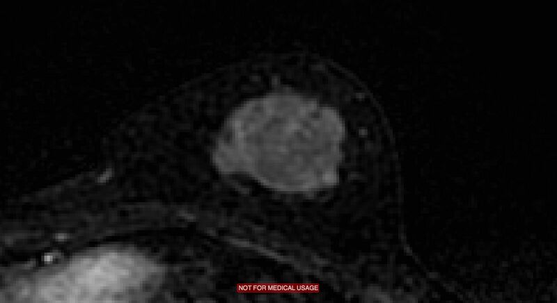 File:Breast lymphoma (MRI) (Radiopaedia 34999-36498 C 13).jpg