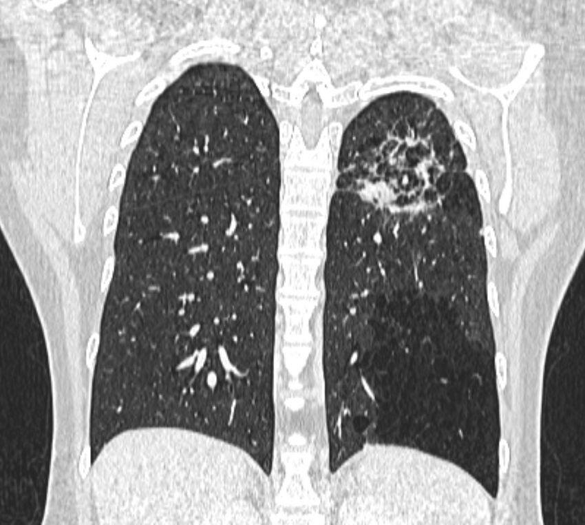Bronchial atresia (Radiopaedia 50007-55297 Coronal lung window 85).jpg
