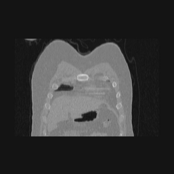 File:Bronchial atresia (Radiopaedia 60685-68439 Coronal lung window 70).jpg